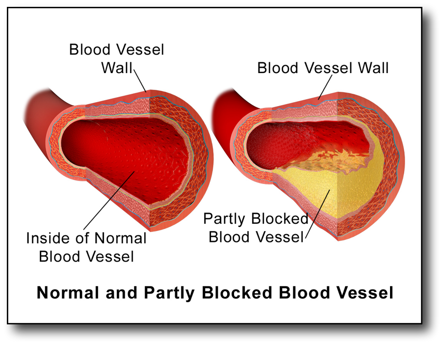 Understanding Cholesterol and Low Carb Diet Blood Vessel Plaque